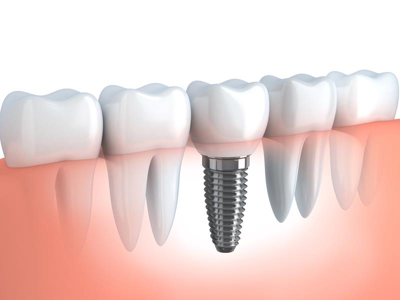 Dental Implants Myrtle Beach, SC